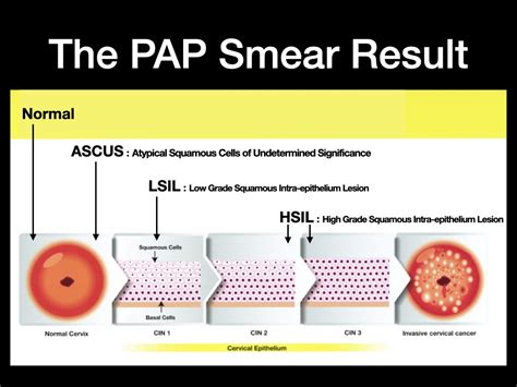 mild inflammation on pap smear|HPV and Pap Test Results: Next Steps after an Abnormal Test.
